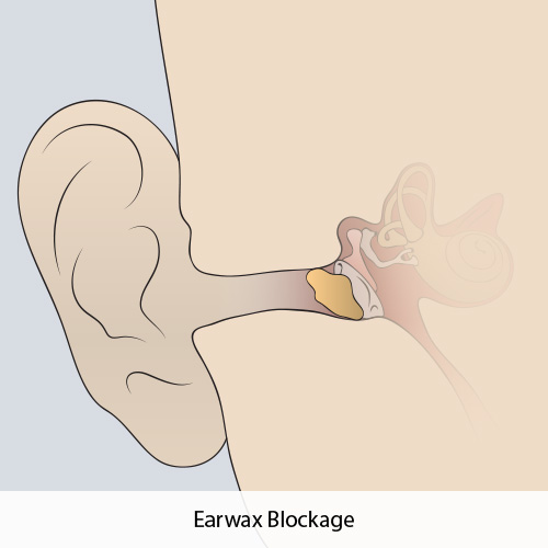 An illustration of earwax blockage