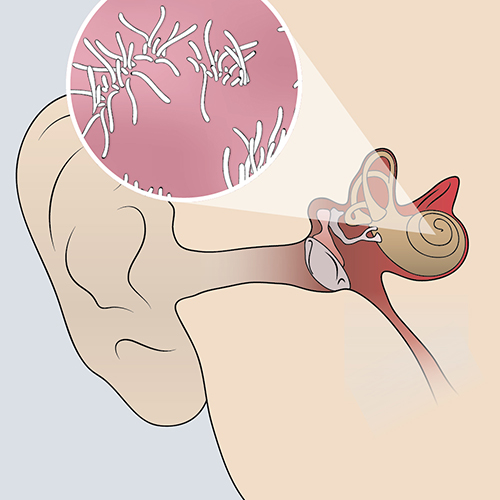 An illustration depicting sensorineural hearing loss