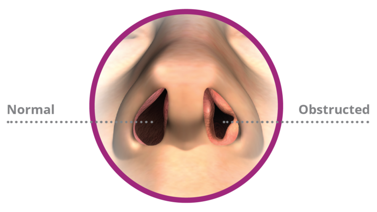 An illustration depicting nasal obstruction